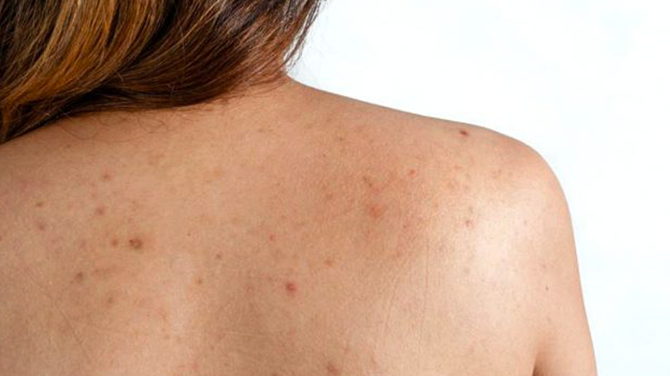 ¿Tienes acné en la espalda? Elimínalo con estos fáciles tips