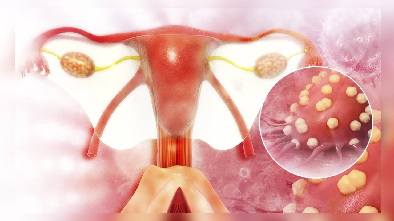 Cáncer de ovarios esperanza de vida